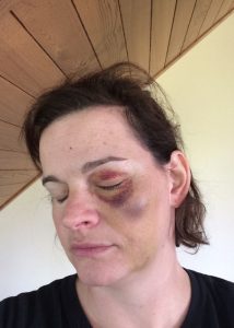 Chantal Ruel après son accident de vélo - ambassadrice pour la Tournée Jamais sans mon Casque - Chaudière-Appalaches